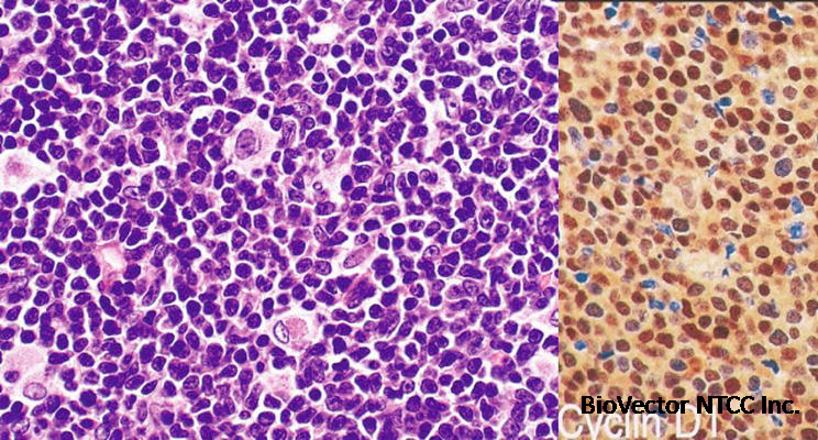 B-Cell Lymphomas | IntechOpen