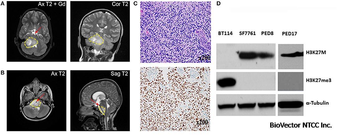Frontiers | Current Murine Models and New Developments in H3K27M Diffuse  Midline Gliomas