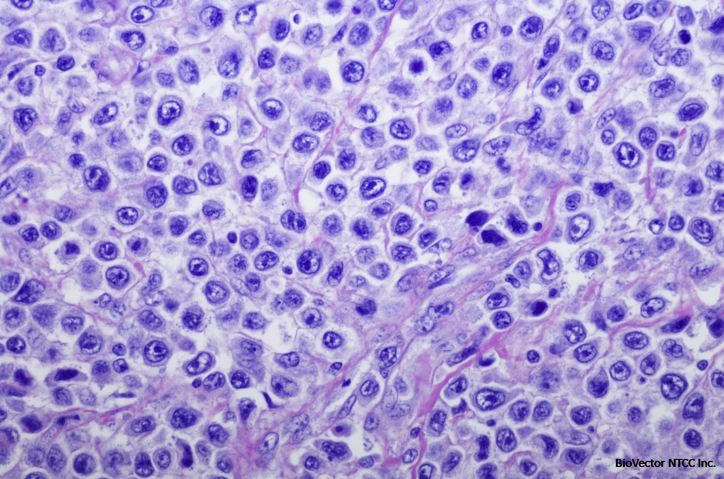 Diffuse Large B-Cell Lymphoma – Karyopharm Therapeutics